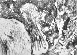 F, 47y. | phagocytosed collagen (unclassified dermal lesion) F, 47y. | phagocytosed collagen (unclassified dermal lesion)